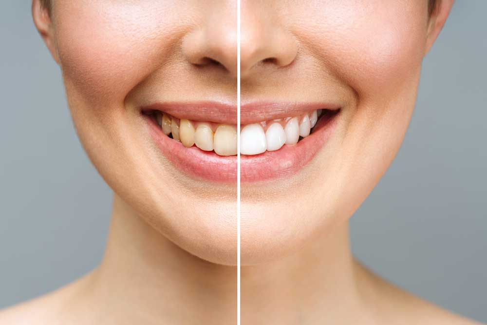 Kvinna som ler där tandblekning visas före och efter